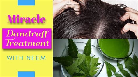 The condition is not an. How to get rid of dandruff with neem | remedies for dandruff | Dandruff treatment, Dandruff ...