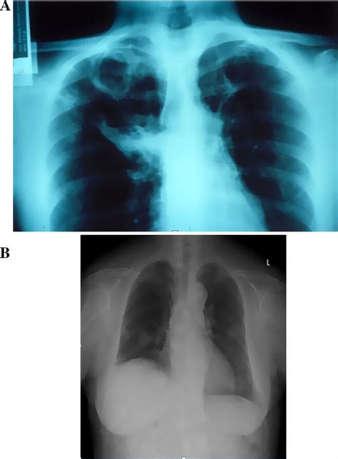 A Chest Radiograph Of A Patient With Cavitary Histoplasmosis