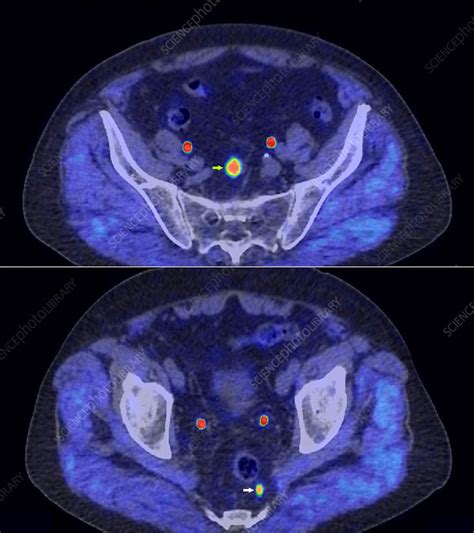 Secondary Lymph Node Cancers Ct And Pet Scan Stock Image C0500898