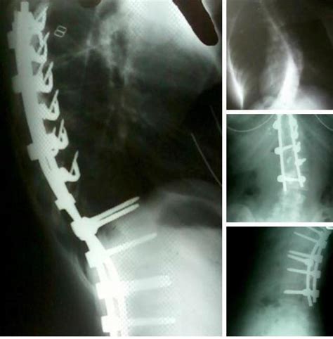 X Rays Of My Pre And Post Op Correction Of Scoliosis Top Right Is