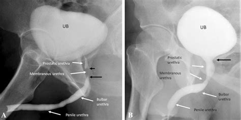 Normal Urethral Anatomy A Retrograde Urethrogram Shows The Anatomical