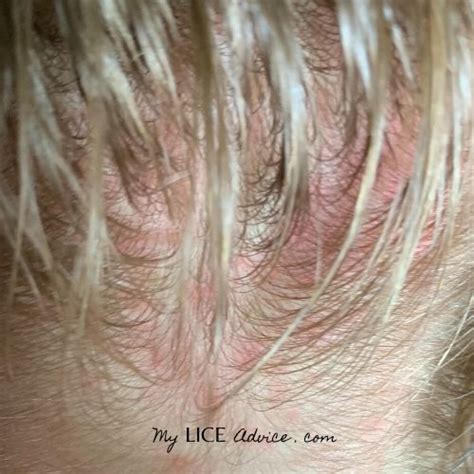 A Closer Look At Lice Bites And Rashes With Pictures My Lice Advice