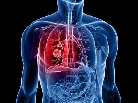 Researchers Figure Out How Lung Cancer Spreads Through The Body