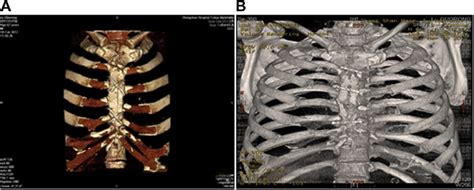 Man 65 Years Old With Sternum Infection 1 Month After The Pericardial