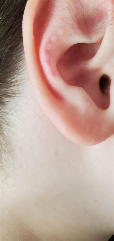 What Are These White Spots On My Sons Ears Dermatologyquestions