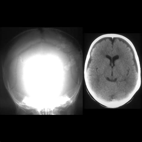 Pediatric Skull Fracture Pediatric Radiology Reference Article