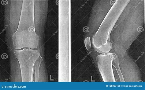 X Rays Of Knee Joint In Two Projections Stock Photo Image Of