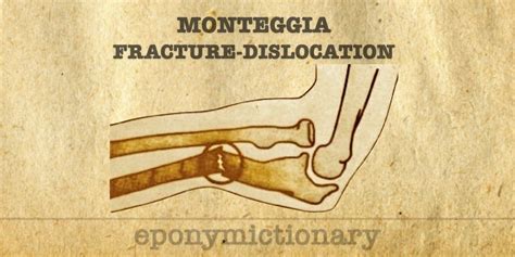 Monteggia Fracture • Litfl • Medical Eponym Library