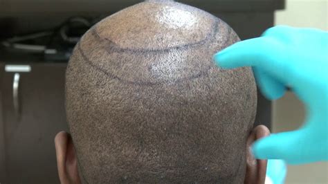 Fue Hair Transplant Scar 1 Year After Follicular Unit Extraction
