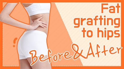 Beforeandafter① Fat Grafting To Hips D Youtube