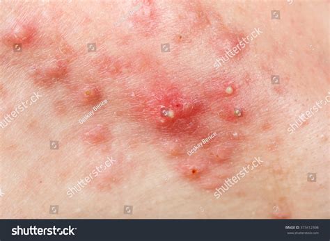 Nodular Acne Images Stock Photos And Vectors Shutterstock