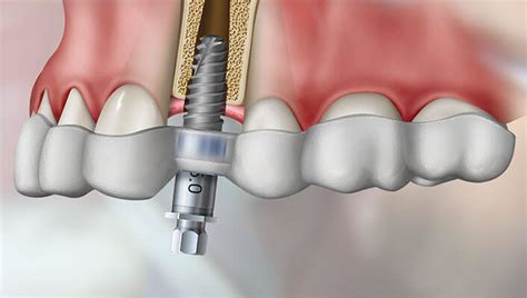 Computer Guided Dental Implant Surgery Toronto Dentist