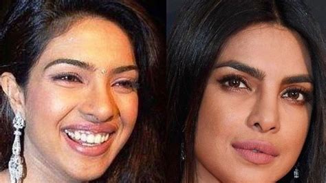 Priyanka Chopra Was Called Plastic Chopra By The Media After A Botched Nose Operation Surgery