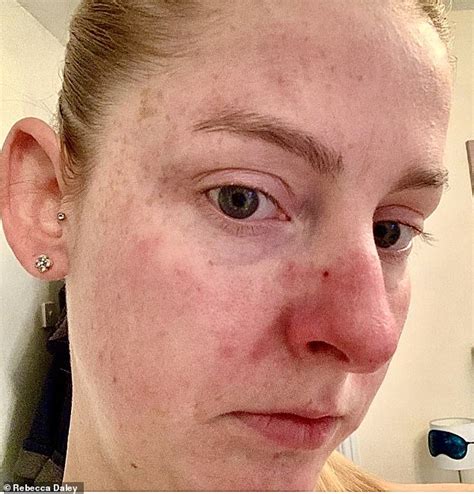 Rosacea Sufferer Claims A Cream Made From Capers Helped To Improve Her