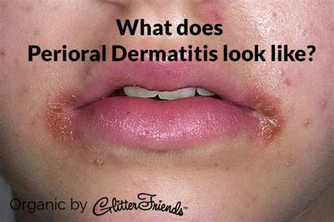 Seborrheic Dermatitis Perioral Dermatitis Around Nose Javsystema