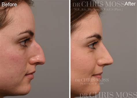 Nose Job Results Rhinoplasty Before And After Dr Chris Moss