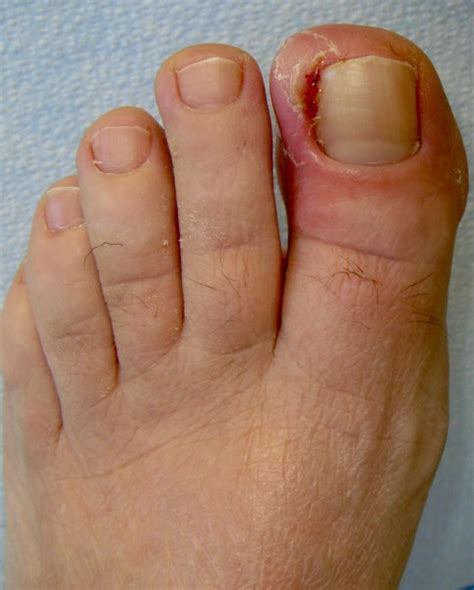 When to see a doctor. Toenails: Ingrown Toenail - Da Vinci Foot and Ankle