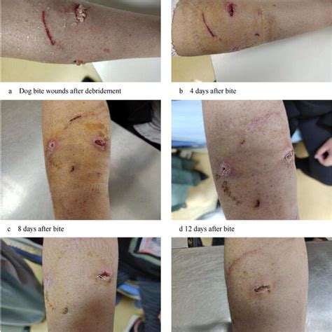 Macroscopic View Of Wound Healing Process After Dog Bite Note The