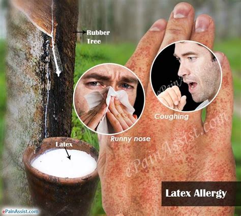 Pin On Allergies