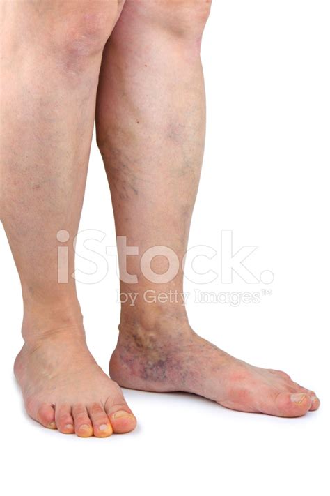 Varicose Veins Stock Photo Royalty Free Freeimages