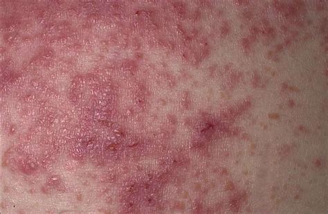 Hoe Dermatitis Herpetiformis Eruit Ziet Med Nl