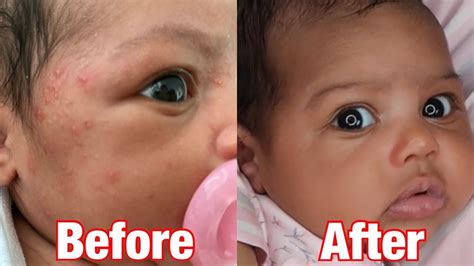 Get Rid Of Baby Acne Fast Bonus Dry Skin Tip Youtube