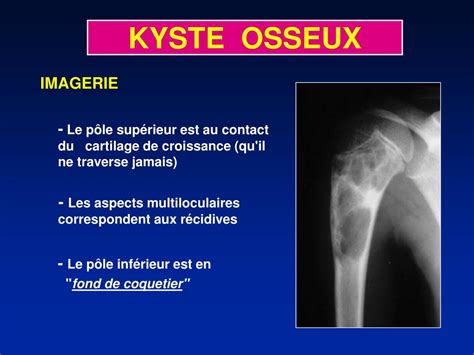 Ppt Kyste Osseux Kyste Solitaire Powerpoint Presentation Free