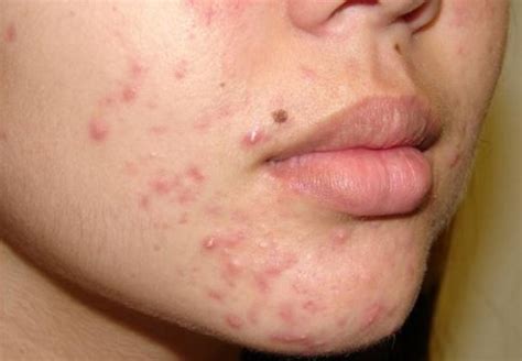 How You Can Get Acne From Your Pillow Hubpages