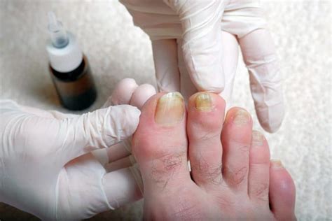 Discoloured Toenails Foot Specialist Toronto Feet First Clinic