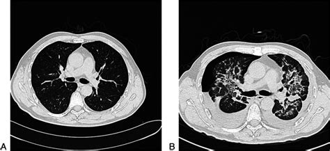 Chest Ct A Chest High Resolution Ct Scan Showed Normal Before Gist