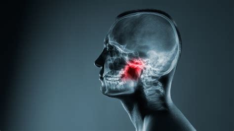 Understanding Osteonecrosis Of The Jaw Cancerconnect