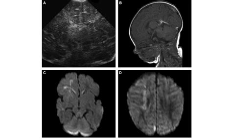 Cranial Ultrasound And Magnetic Resonance Imaging Mri Findings Of An