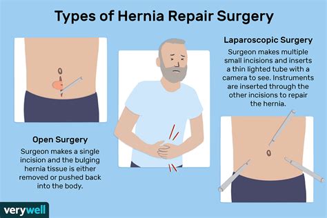 How To Repair Umbilical Hernia How To Do It