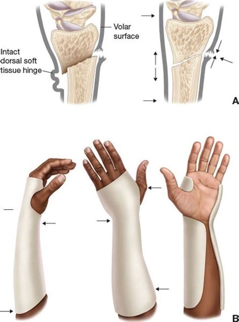 Management Of Wrist Fractures Plastic Surgery