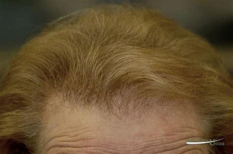 Severe Female Hair Loss Dr Robin Unger Dr Robin Unger Hair