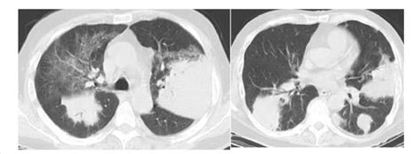 Bacterial Pneumonia Ct Scan Of The Chest Shows Ground Glass Opacities