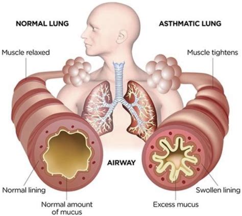 Asthma Lung Diagram Kingwood Emergency Hospital