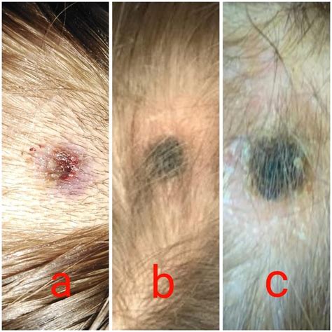 The Most Important Symptoms Of Tibola Eschar In The Scalp White