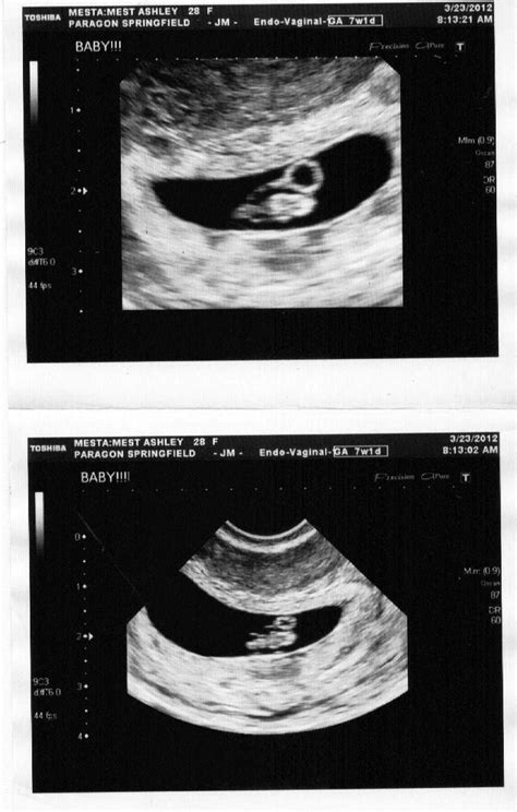 7 Weeks Baby Ultrasound Image Ababyw