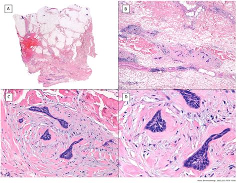Translated Article Histologically Agressive Basal Cell Carcinoma With