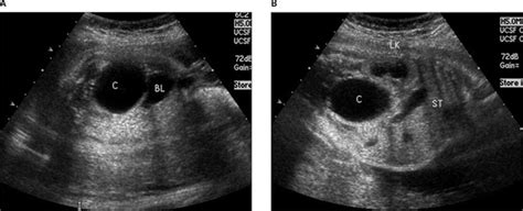 The Fetal Urinoma Revisited Yitta Journal Of Ultrasound In Medicine Wiley Online