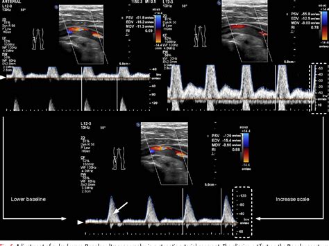 Pdf Doppler Ultrasonography Of The Lower Extremity Arteries Anatomy Sexiz Pix