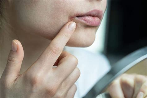 How To Heal Cracked Lip Corners Fast