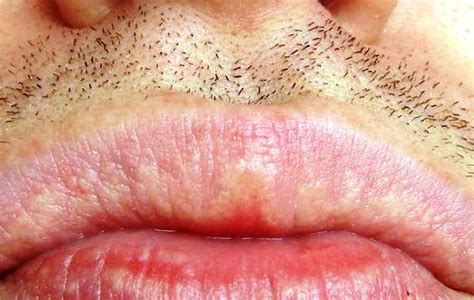 Fordyce Spots On Lips Causes Pictures Contagious Removal