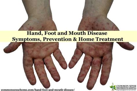 Hand Foot Mouth Disease Adults Symptoms Pictures