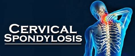 Cervical Spondylosis Causes Symptoms Treatment And Exercises High