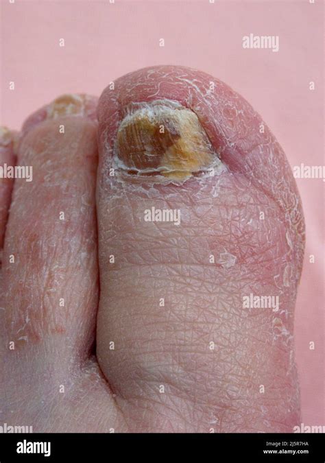 Brittle Toenails Hi Res Stock Photography And Images Alamy
