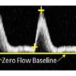Spectral Doppler Waveforms Demonstrate A Laminar B Disturbed And