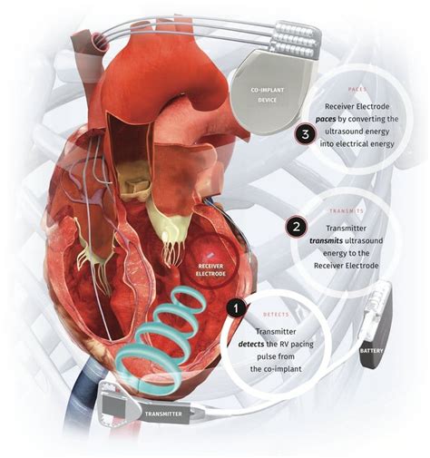 Wise Cardiac Resynchronization Therapy Crt System By Ebr