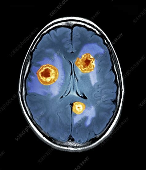 Secondary Brain Cancer Mri Scan Stock Image C0095518 Science